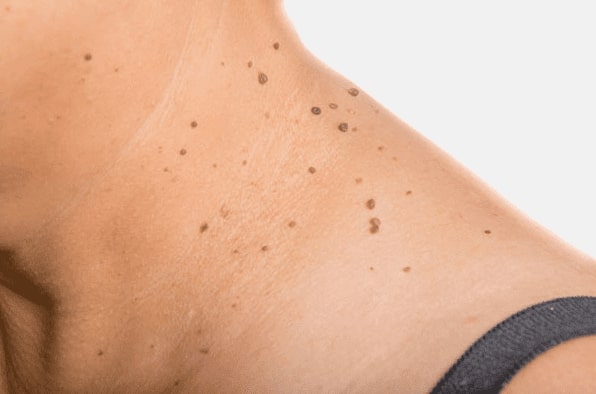 Are you looking for easy skin tag removal Healey - then contact Spire today!