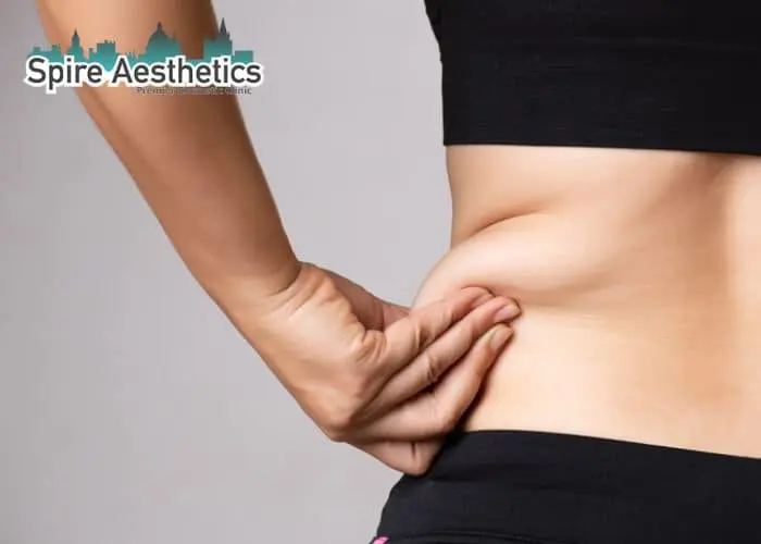 Image of woman pinching fat on their hips Healey. Fat Freezing treatment