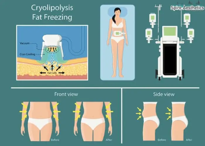 Fat freezing treatment Healey benefits for competitions to remove stubborn fat deposits.