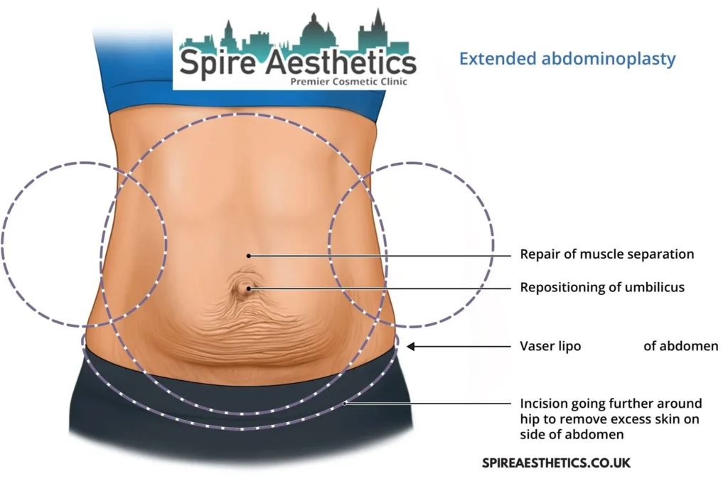 Understanding Loose Skin After Gastric Band Healey Surgery and HIFU Treatment