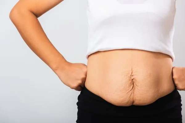 Image of a woman's stomach after weight loss with sagging skin following a gastric band Healey