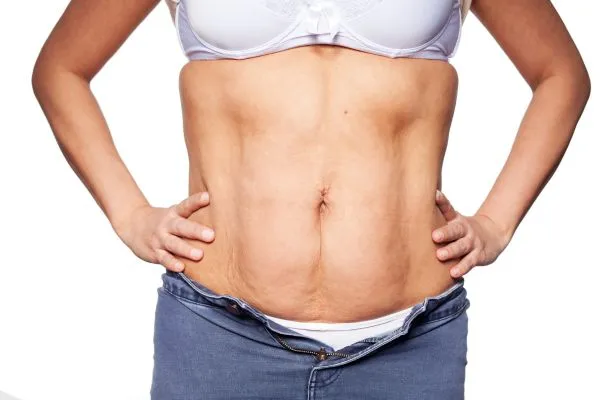 sagging skin on woman's stomach after weight loss injections Healey
